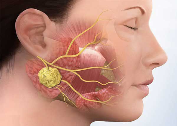 Dấu hiệu nhận biết sớm ung thư vòm họng - 2