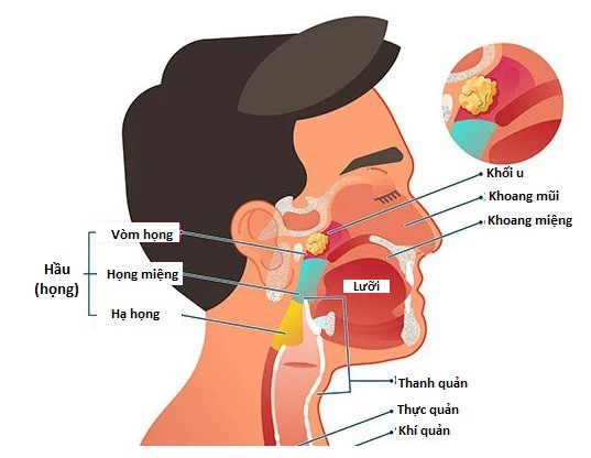 Dấu hiệu nhận biết sớm ung thư vòm họng - 1