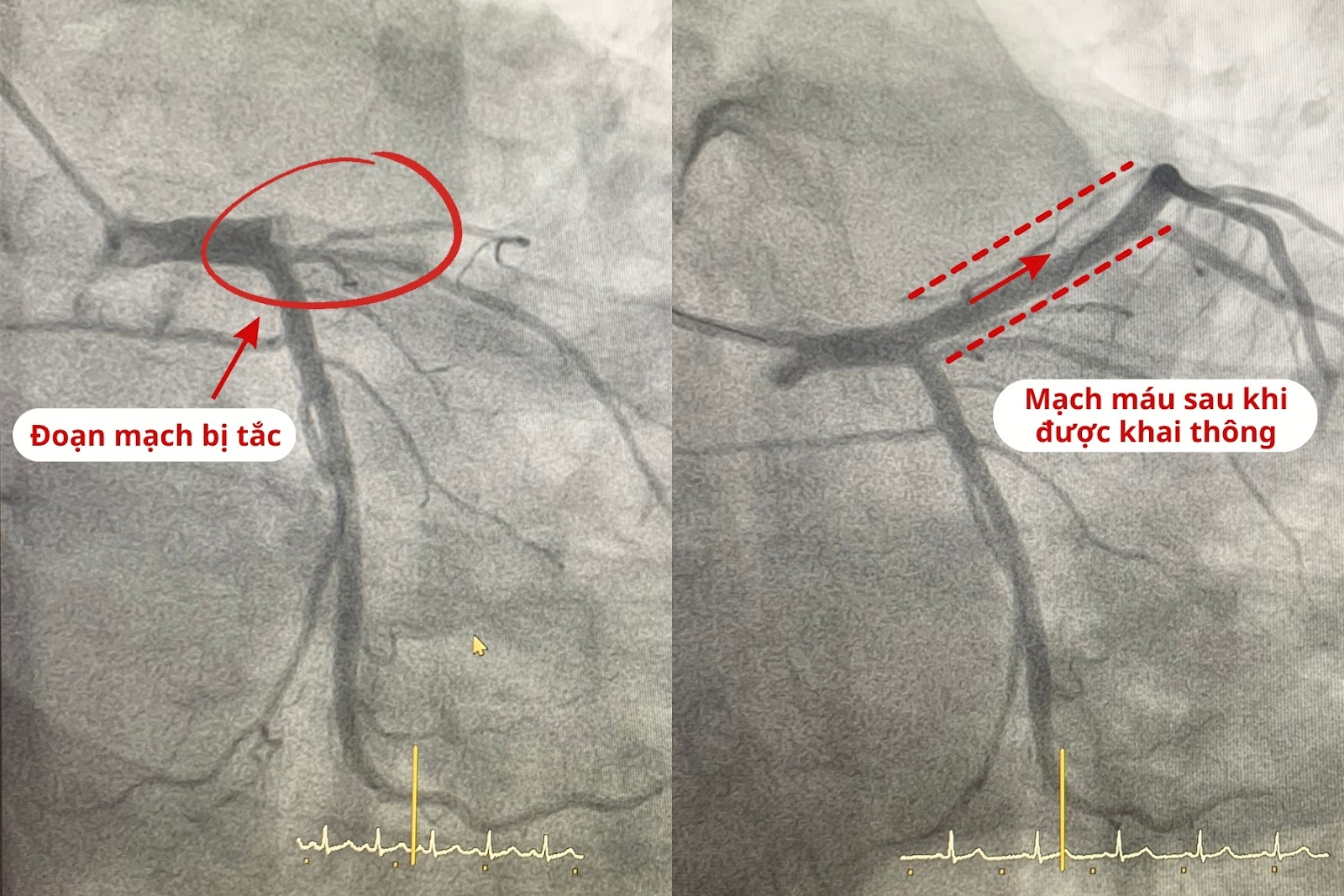 Hình ảnh động mạch vành của bệnh nhân trước và sau can thiệp đặt stent