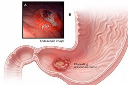 Phó Giám đốc Bệnh viện K chỉ rõ dấu hiệu cảnh báo sớm ung thư dạ dày