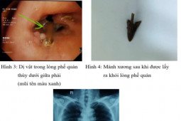 Người đàn ông nhập viện sau 1 tháng ăn thịt gà, bất ngờ trước thủ phạm