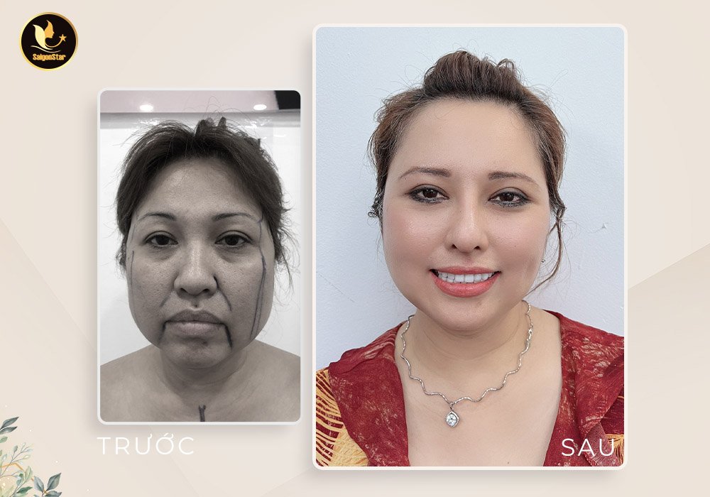 Bác sĩ Nguyễn Hữu Hoạt đưa “thanh xuân” về cho chị em bằng công nghệ căng da mặt nội soi - 2