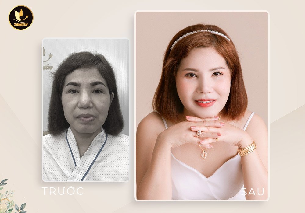 Bác sĩ Nguyễn Hữu Hoạt đưa “thanh xuân” về cho chị em bằng công nghệ căng da mặt nội soi - 3