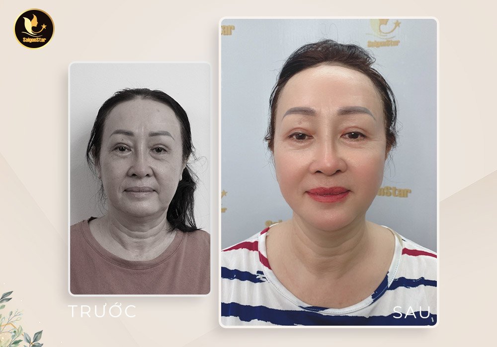 Bác sĩ Nguyễn Hữu Hoạt đưa “thanh xuân” về cho chị em bằng công nghệ căng da mặt nội soi - 4