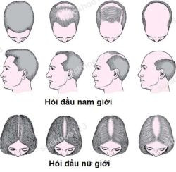 Tóc rụng nhiều, thưa mỏng kèm chân tóc trắng thì là bệnh gì? Giải pháp để kích thích tóc mọc nhanh, chắc khoẻ - 3