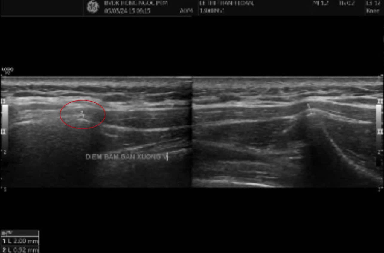 Kết quả siêu âm cho thấy gân bả vai phải dày hơn và có dấu hiệu viêm so với bên còn lại