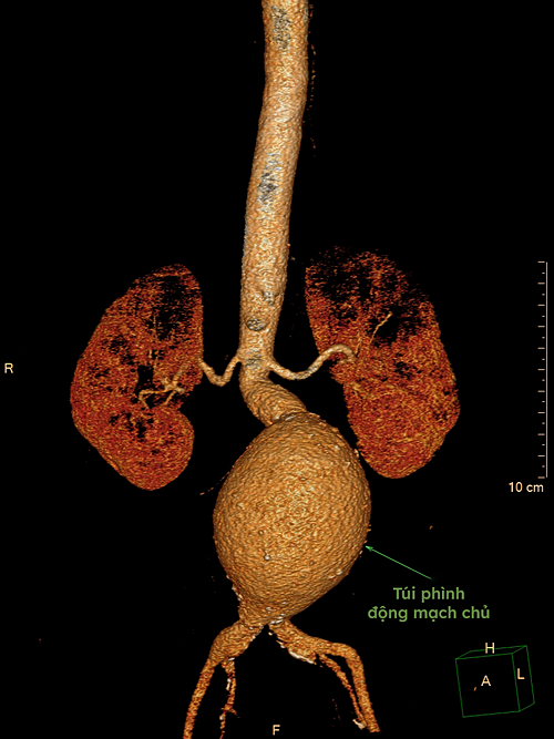 Hình ảnh khối phình động mạch chủ của người bệnh. Ảnh: Bệnh viện cung cấp