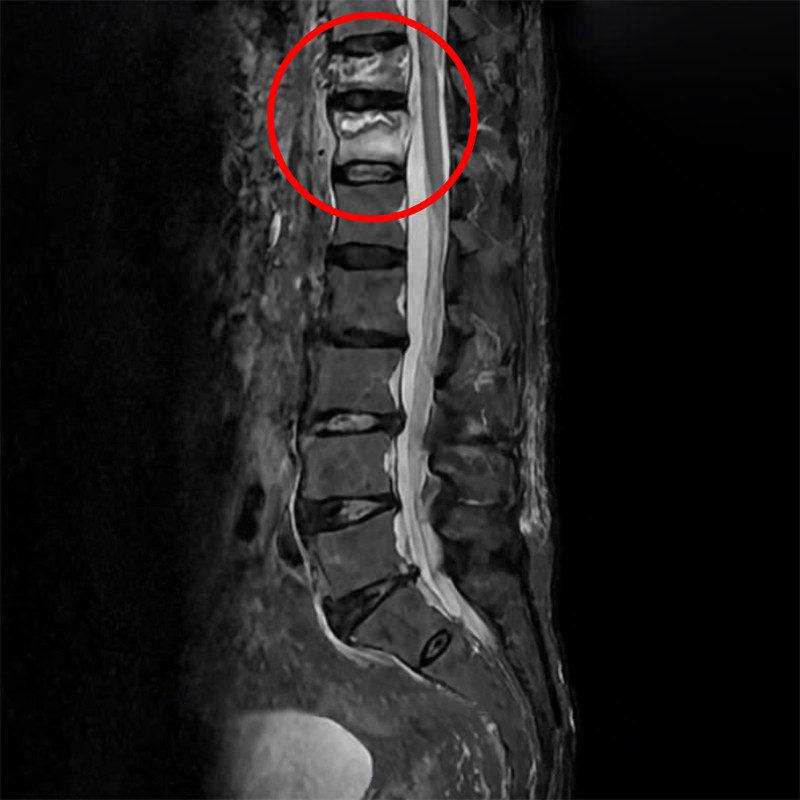 Kết quả phim chụp đốt sống T11, T12 bị vỡ, xẹp của cụ ông 96 tuổi