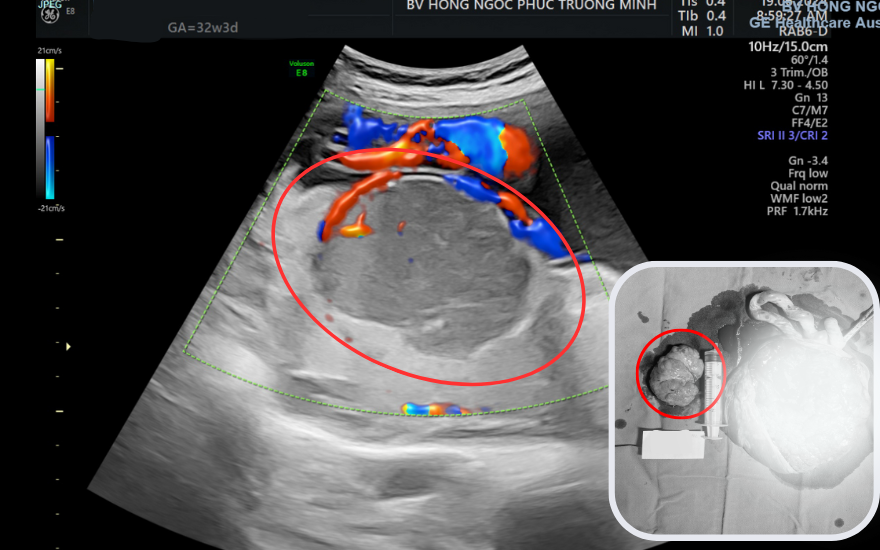 Hình ảnh siêu âm và thực tế của khối u máu bánh nhau kích thước 6x10cm
