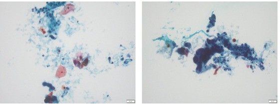 Xét nghiệm phết tế bào cổ tử cung&nbsp;cho thấy sự hiện diện của tế bào ung thư biểu mô vảy