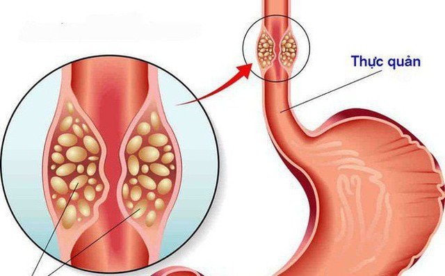 Người đàn ông 53 tuổi phát hiện ung thư thực quản thừa nhận một sai lầm nhiều người Việt mắc phải - 3