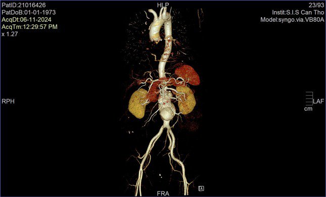 Động mạch chủ bụng của bệnh nhân bị phình lớn dọa vỡ, đe dọa tính mạng
