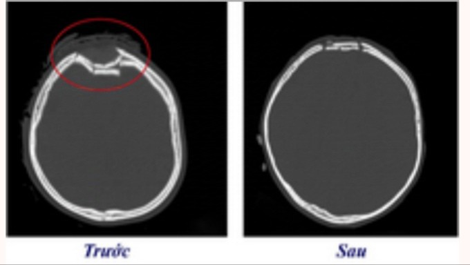 Hình ảnh sọ não bị lún của trẻ trước và sau khi phẫu thuật. Ảnh: BVCC